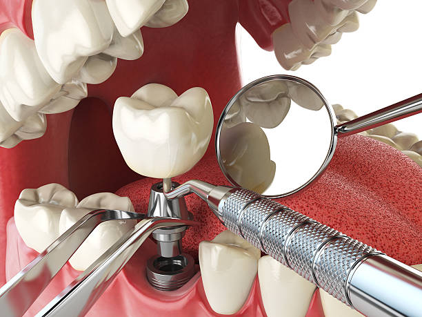 Best Emergency Tooth Extraction in Melbourne, FL